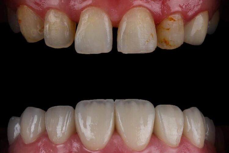 Вініри на зуби: як створюють голлівудську усмішку