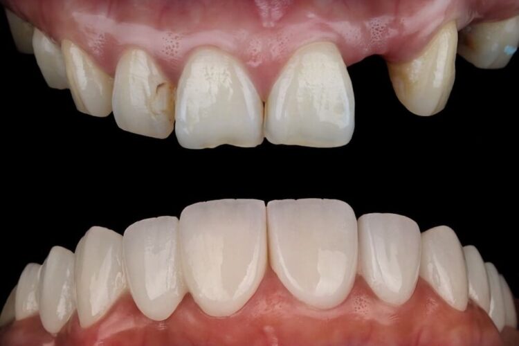 Вініри на зуби: як створюють голлівудську усмішку