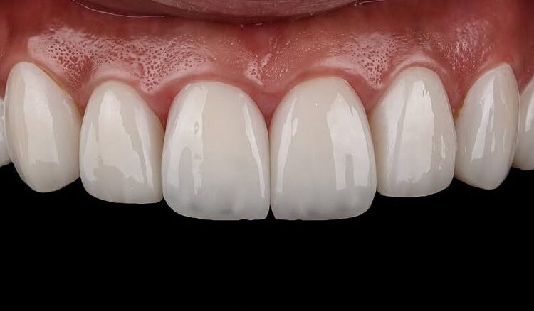 Вініри на зуби: як створюють голлівудську усмішку