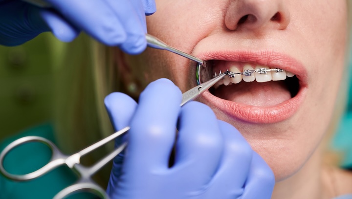 брекети або вініри, що краще