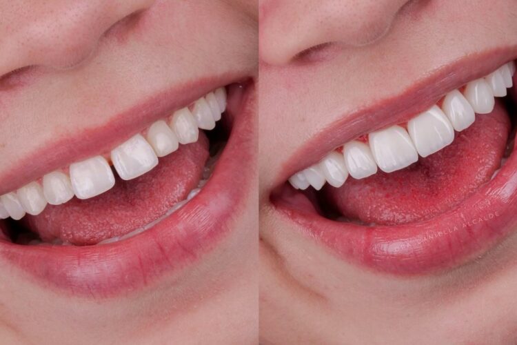 Вініри коли є невеликі щілини між передніми зубами, легка асиметрія, нерівні краї або різниця у формі.