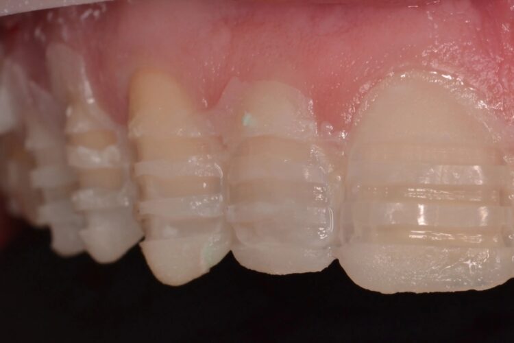 Вініри на криві зуби: коли це працює, а коли створює проблеми