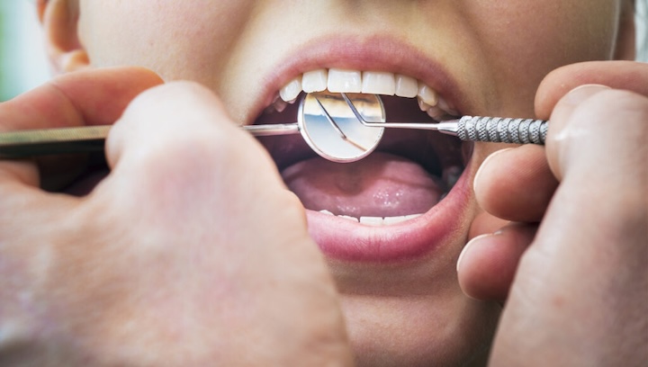 ретейнери — спеціальні фіксатори, які утримують зуби в новому положенні після брекетів або елайнерів