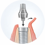 Імплантація "під ключ"