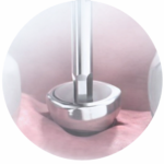 Імплантація "під ключ"