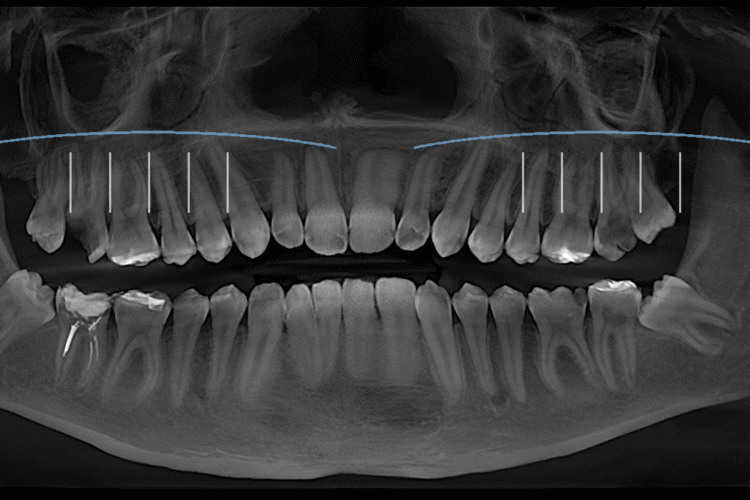 чому зуби болять при застуді