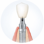 Імплантація "під ключ"