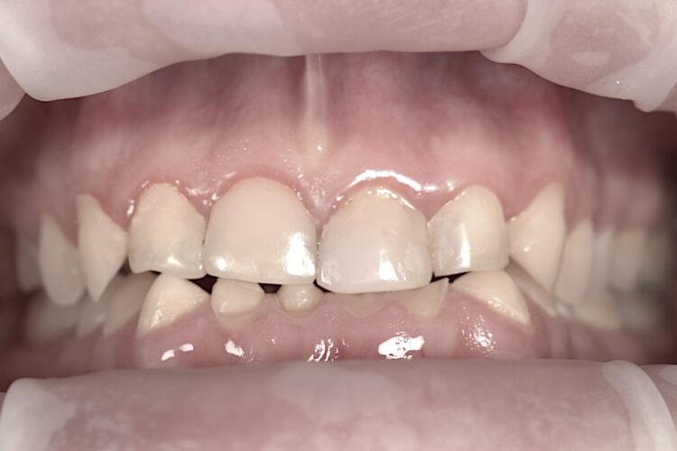 Чому пломба не тримається