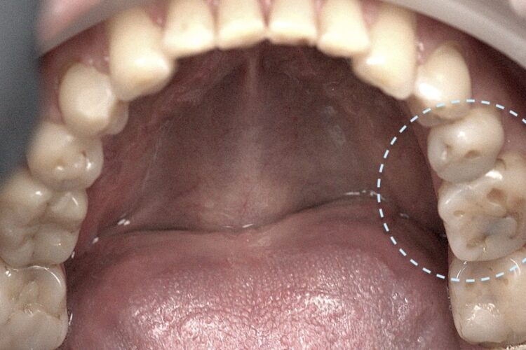 Чому пломба не тримається