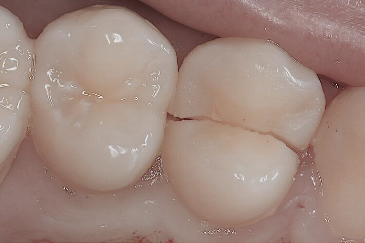 Випала пломба, причини та що робити