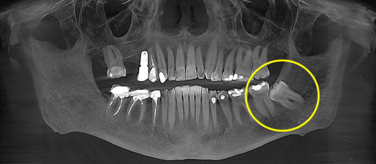 Видалення зуба мудрості