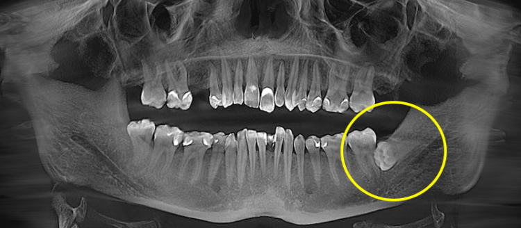 видалення зуба