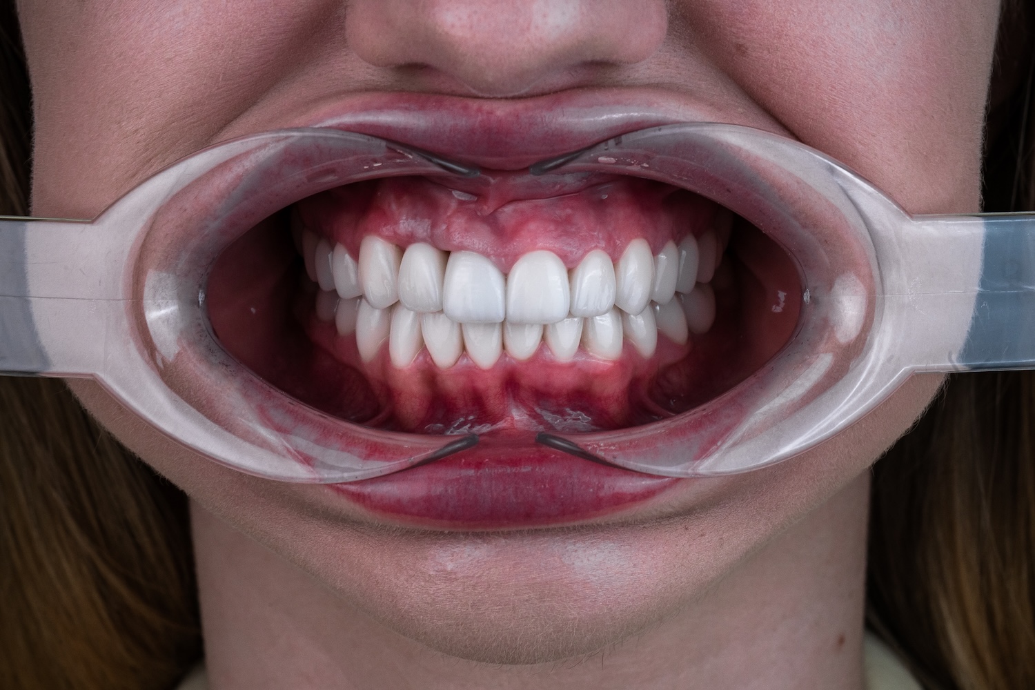 Протезування коронками e.max після вирівнювання зубів