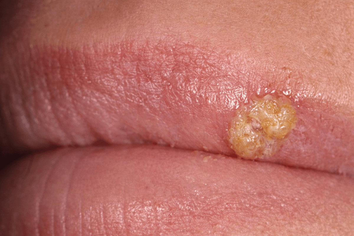 герпес на губі