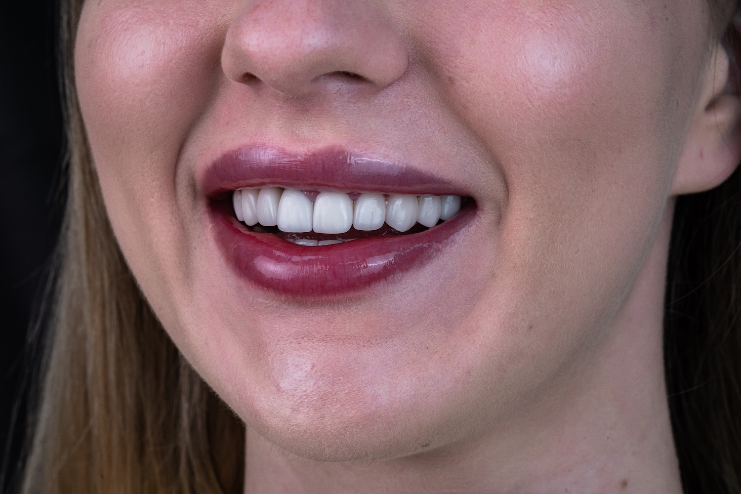 Протезування коронками e.max після вирівнювання зубів