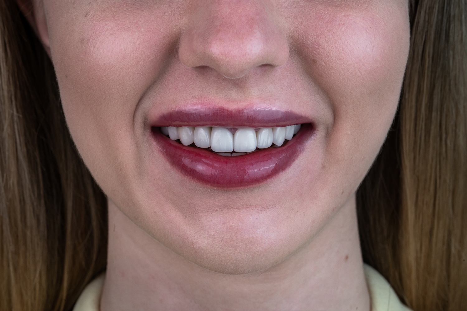 Протезування коронками e.max після вирівнювання зубів