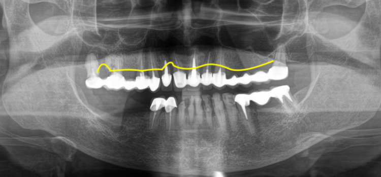 Чи можна робити імплантацію при пародонтозі