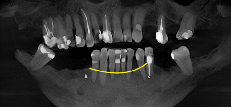 Чи можна робити імплантацію при пародонтозі