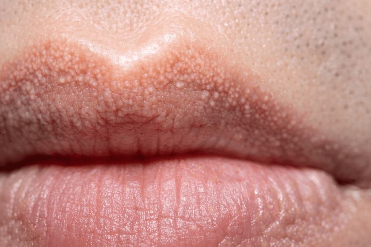 плями Фордайса на губі