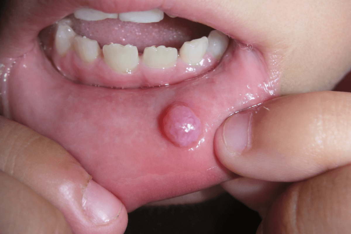 кіста на губі