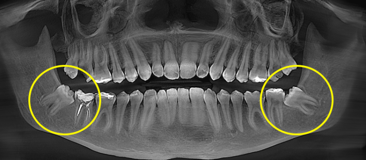видалення зуба