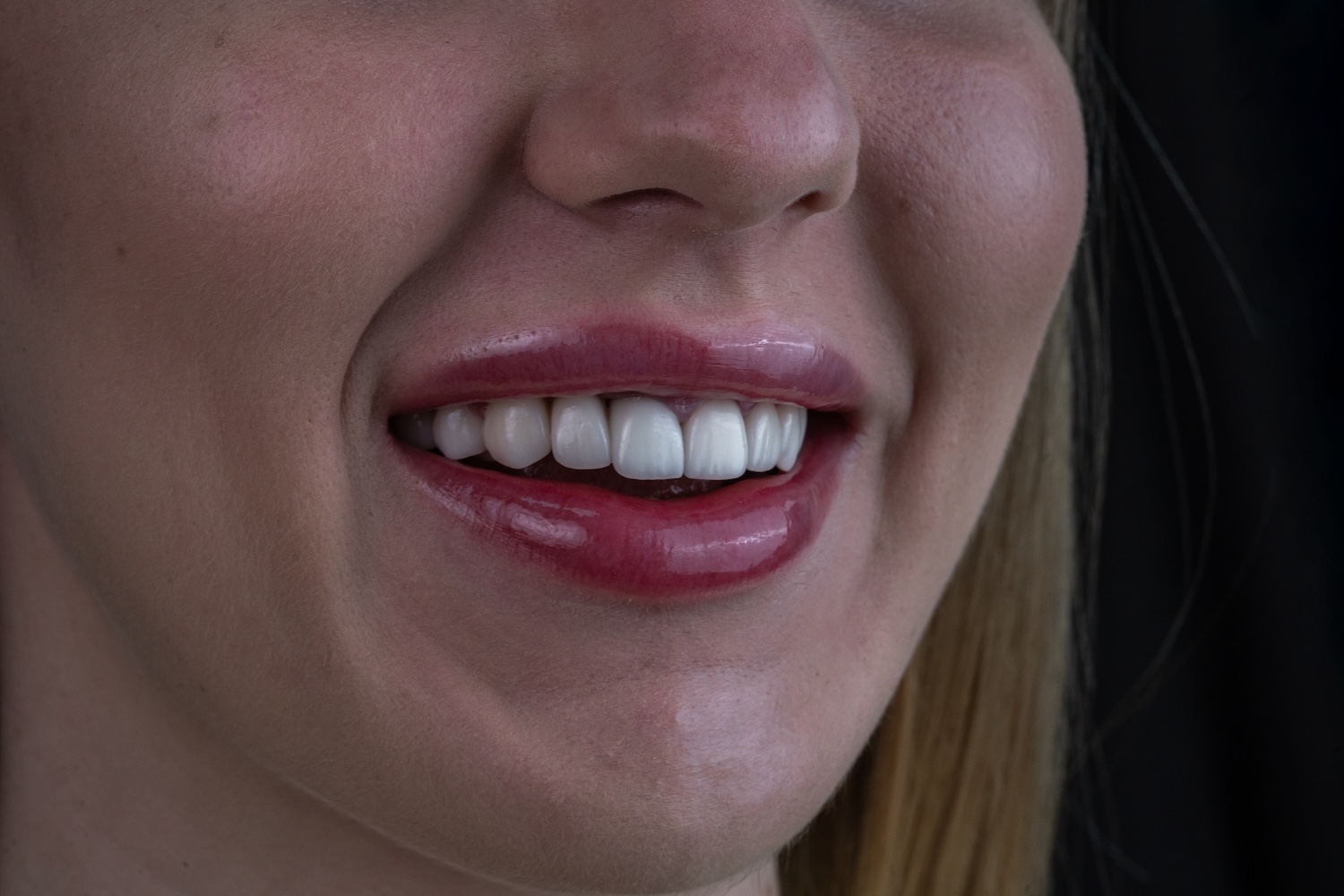 Протезування коронками e.max після вирівнювання зубів