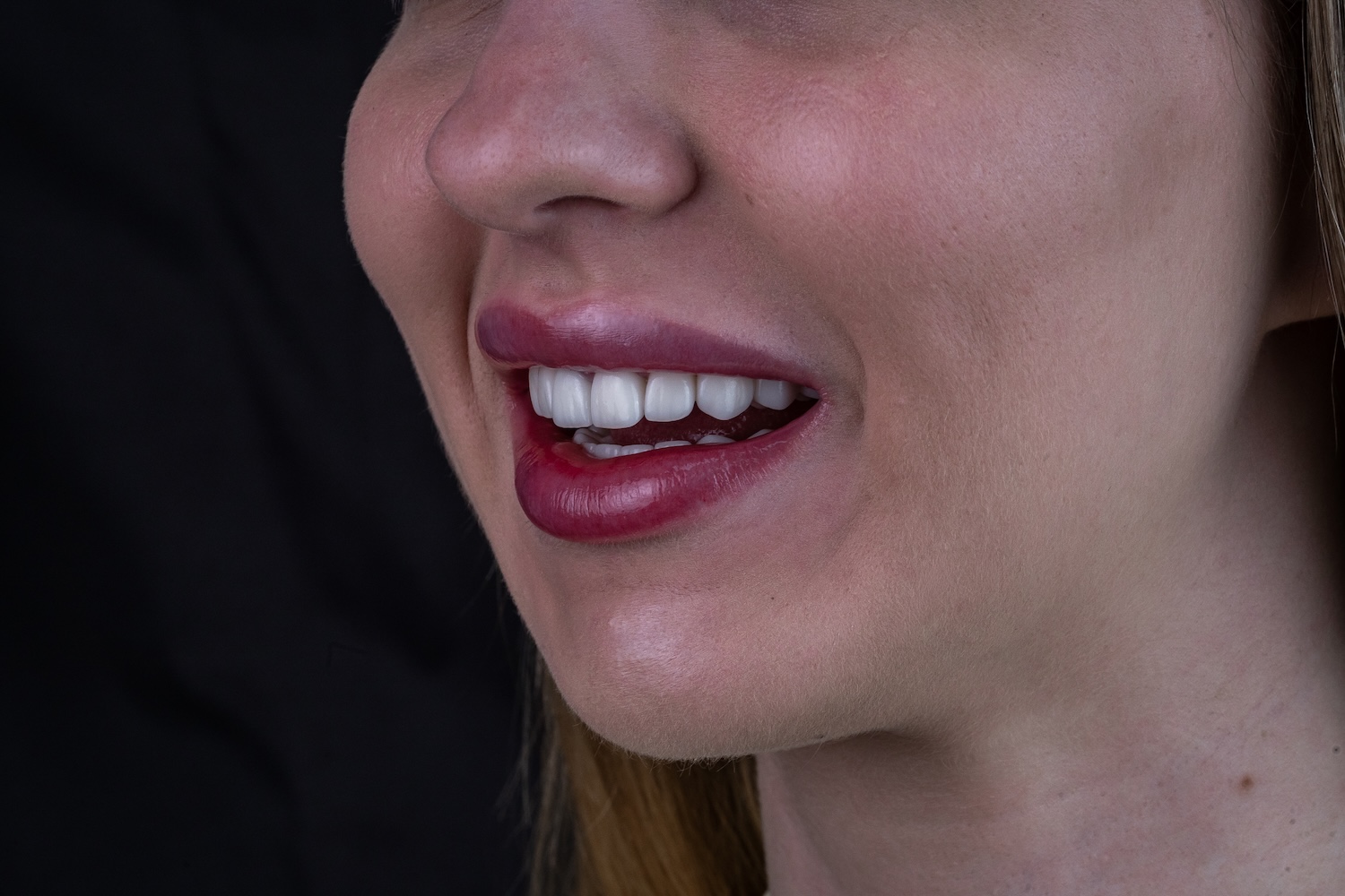 Протезування коронками e.max після вирівнювання зубів