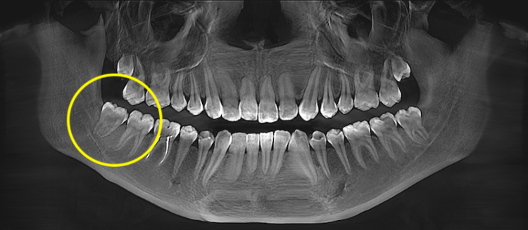 видалення зуба