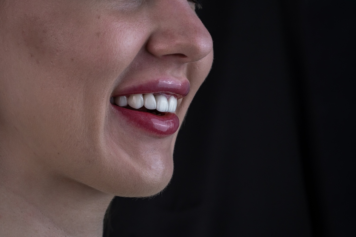 Протезування коронками e.max після вирівнювання зубів