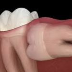 Видалення зуба мудрості