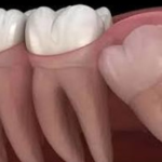 Видалення зуба мудрості