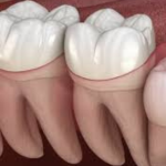 Видалення зуба мудрості