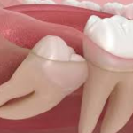 Видалення зуба мудрості