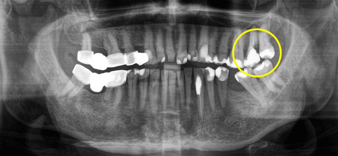Чому руйнується зуб під пломбою або коронкою